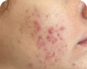 Antes do tratamento de acne