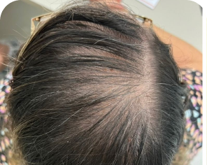 Antes do tratamento de alopecia feminina