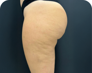 Antes do tratamento de celulite