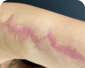 Antes do tratamento de cicatriz