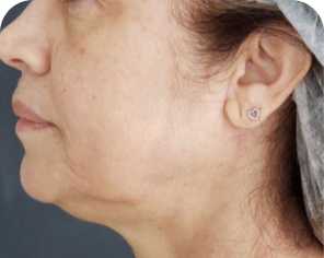 Antes do tratamento de flacidez