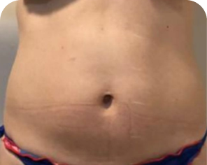 Antes do tratamento de gordura localizada