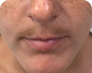 Antes do tratamento de manchas