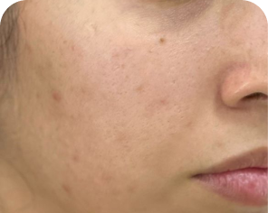 Antes do tratamento de qualidade de pele